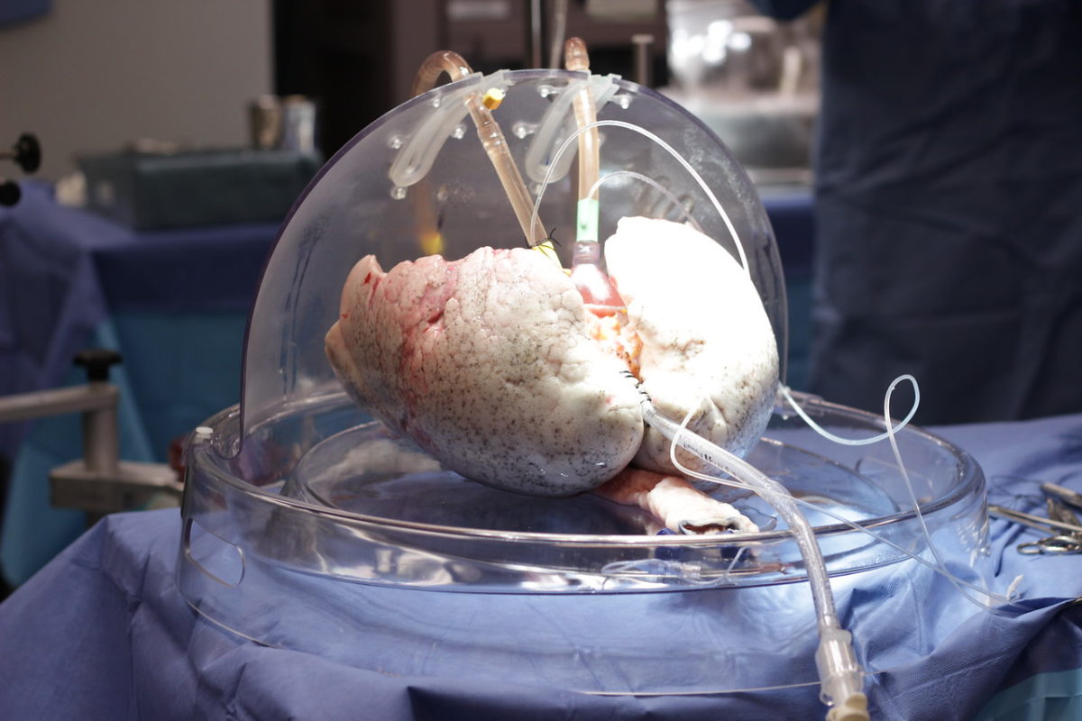 Hepatitis C lungs being treated with the Ex Vivo